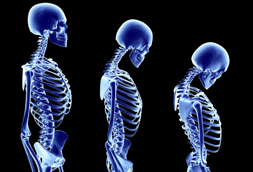остеопороз, Romosozumab, sclerostin