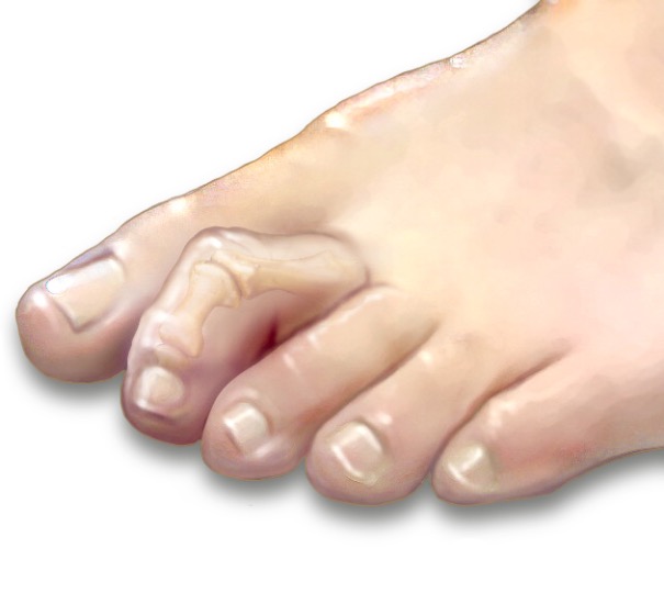 Молоткообразная деформация пальцев стоп: причины, симптомы и лечение