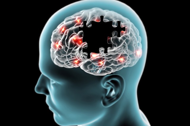 Неинвазивное ультразвуковое сканирование мозга может стать прорывом в лечении болезни Альцгемера