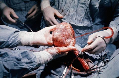 трансплантации сердца