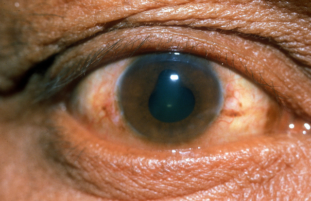 микрофлора кишечника, заболевания глаз