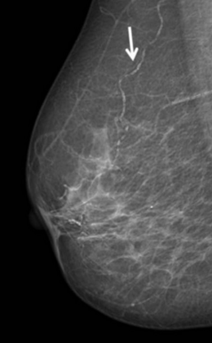 маммография, сердечно-сосудистые заболевания,