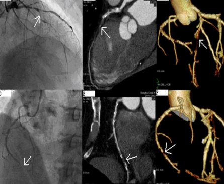 Journal of the American College of Cardiology: Cardiovascular Imaging, индекс кальция, сердечно-сосудистые заболевания