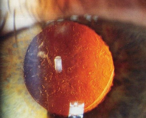 витамин С, катаракта, Ophthalmology