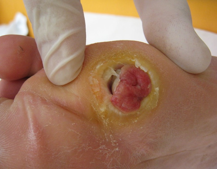 Ампутация пальца стопы при сахарном диабете thumbnail