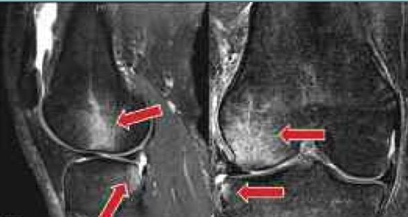 Ушиб костного мозга колена thumbnail