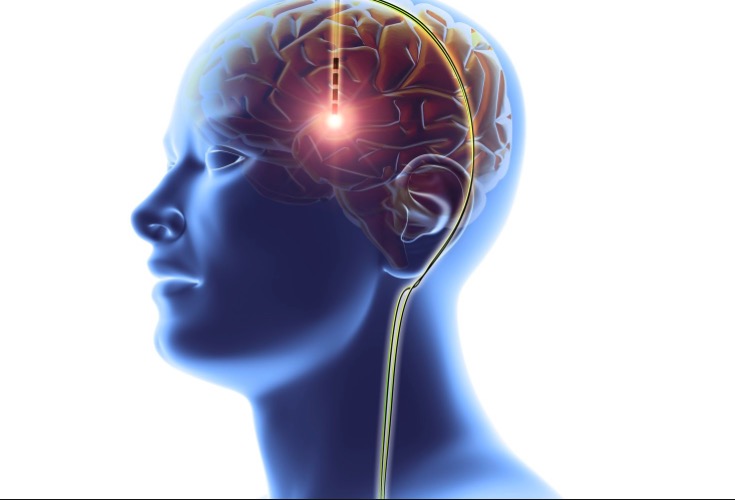 анорексия, стимуляция головного мозга