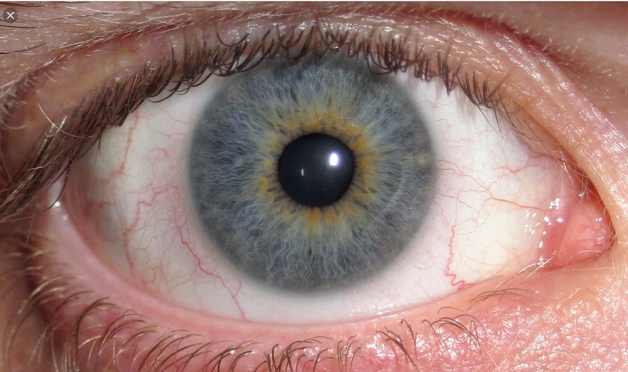 Центральная гетерохромия Радужки глаз