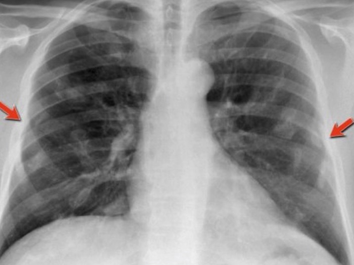 Что такое двусторонняя пневмония и чем она опасна thumbnail