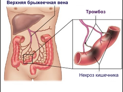 тромбоз брыжеечных вен, тромбоз брыжеечной вены симптомы