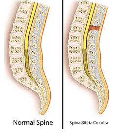 Spina bifida occulta, скрытое незаращение позвоночника, Spina bifida occulta - причины, Spina bifida occulta лечение