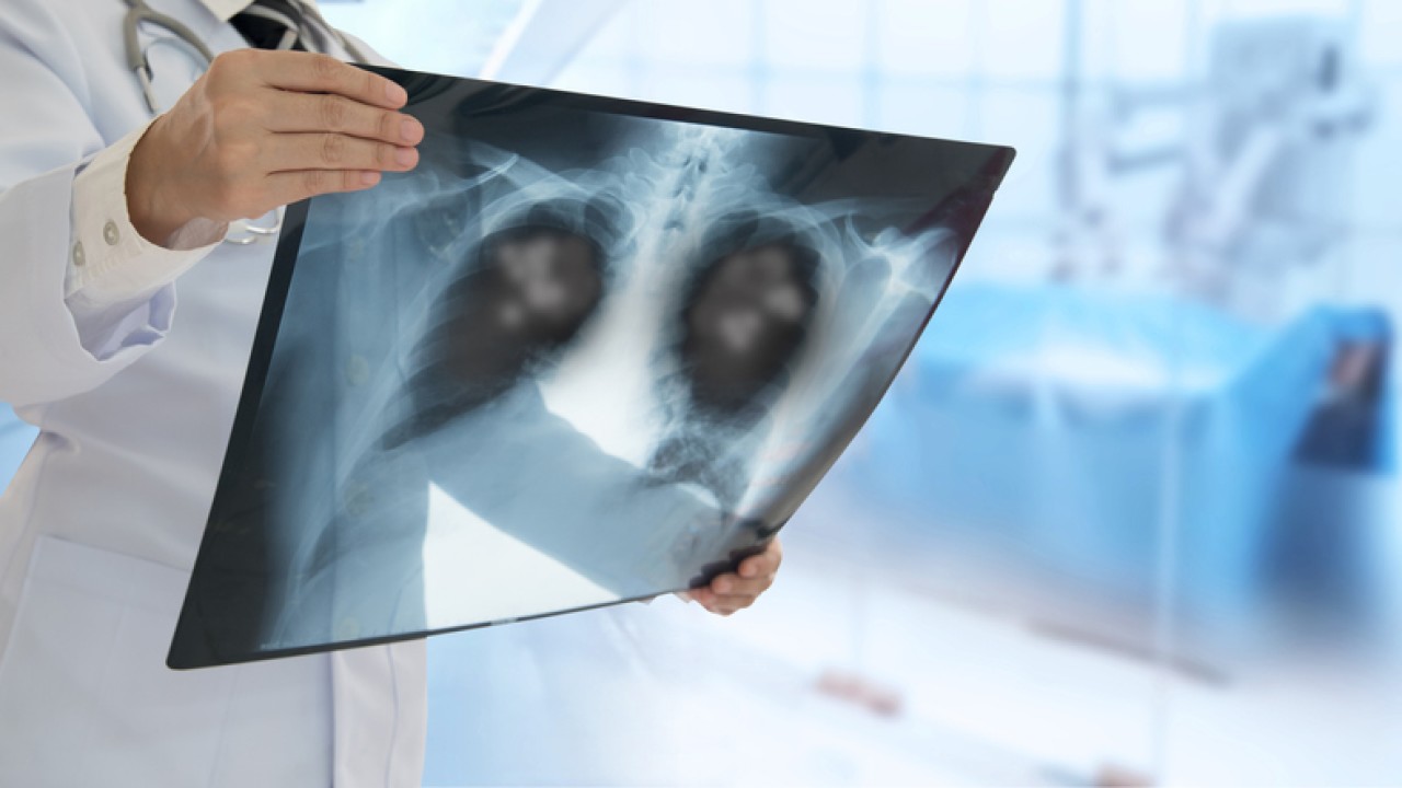 Как отличить пневмонию от рака на рентгене thumbnail