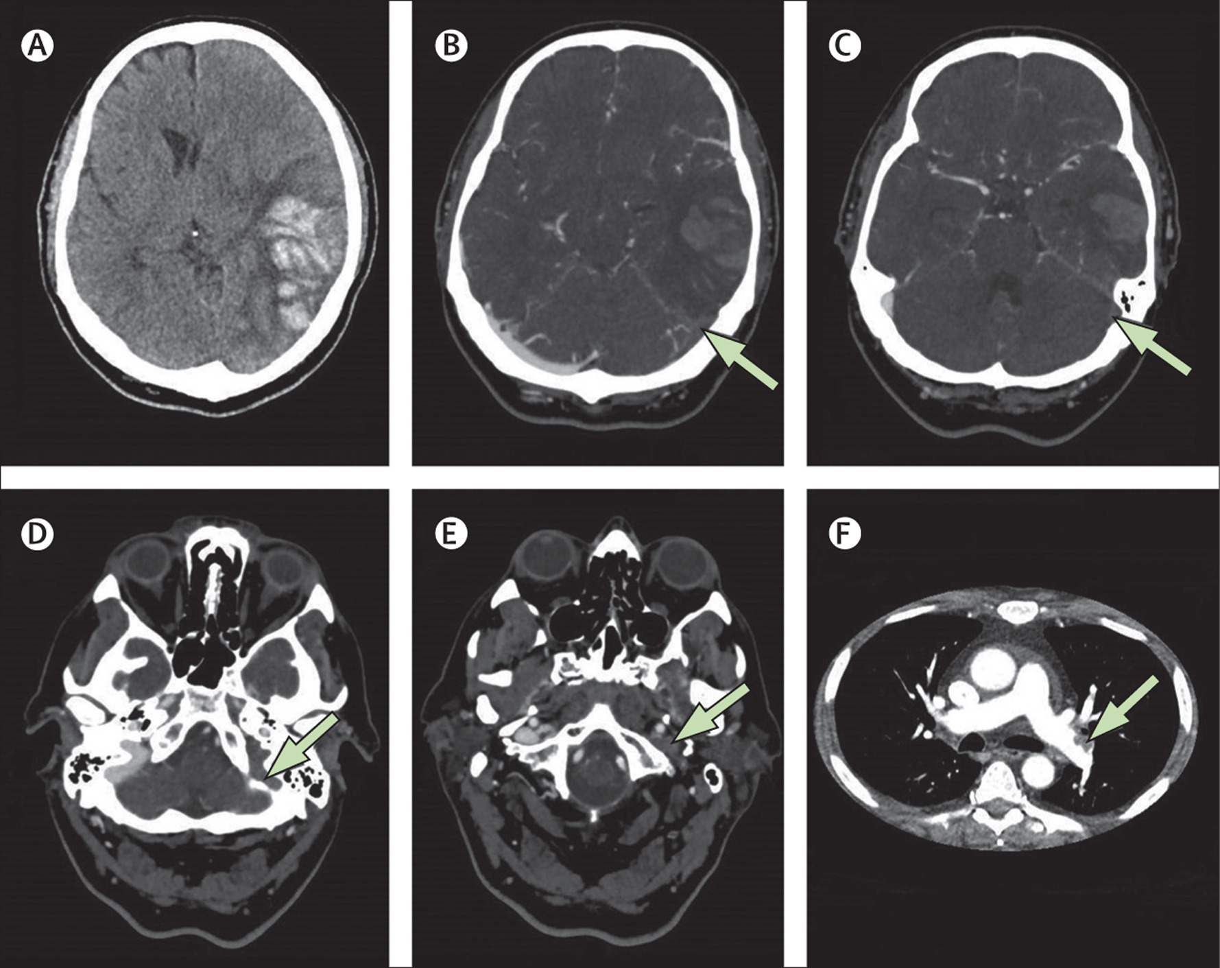 Микроангиопатия на мрт. Микроангиопатия головного мозга что это такое. Церебральной микроангиопатии. CT angiografia cerebral Vein trombosis.