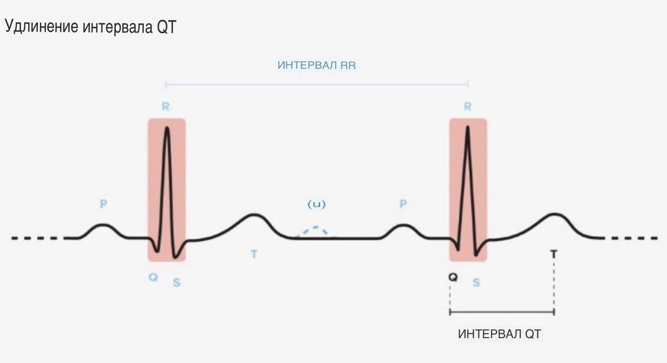 Удлинение интервала qt